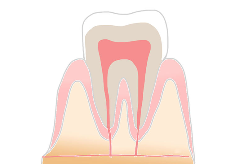 C0～初期段階の虫歯状態