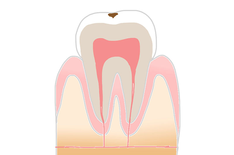 C1～エナメル質の虫歯状態