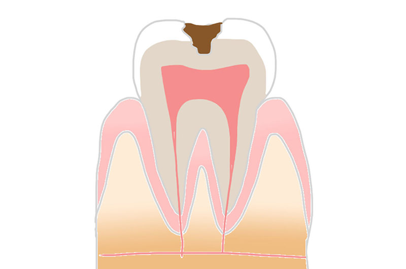 C2～象牙質の虫歯状態