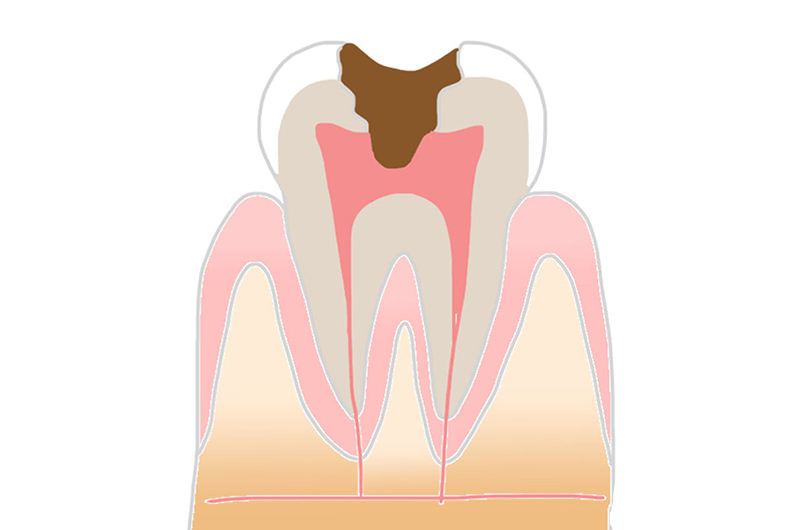 C3～神経の虫歯状態
