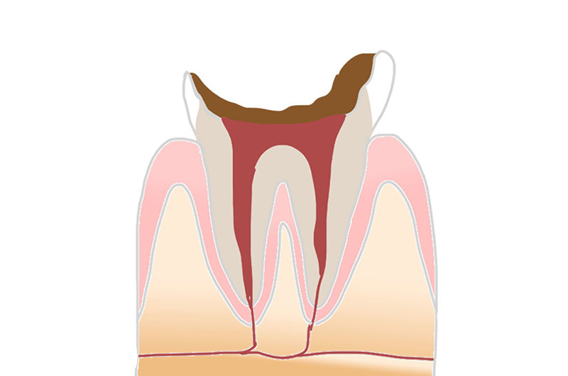 C4～末期の虫歯状態